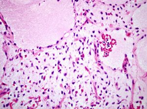 Myxoid sarcoma